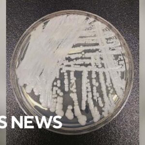 CDC issues warning about a fungus called Candida auris