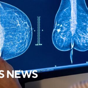Why experts say mammograms should start at age 40