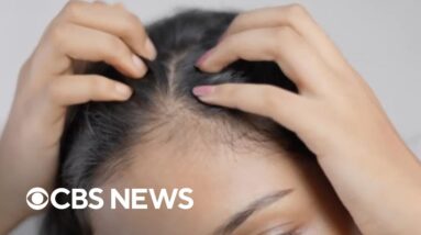 40% of women affected by female pattern hair loss by age 50, study finds