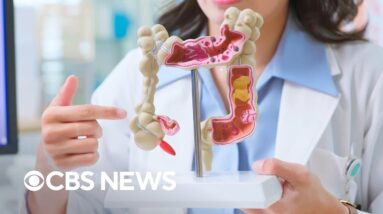 What's fueling the rise of colon cancer in young people?