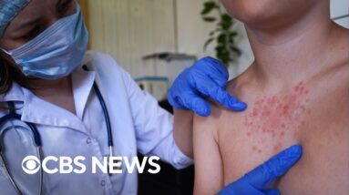 U.S. records highest number of measles cases since 1992, CDC says